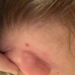 Bug bites behind ear Bug bites behind ear