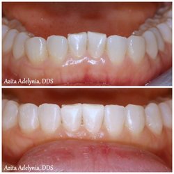 Anaheim Hills Smile Studio - Before and after Invisalign