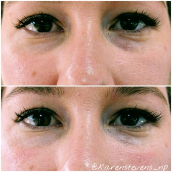 A Perfect You - Tear trough filler before and after - Medical Spas Near Me - Las Vegas, Nevada A Perfect You - Tear trough filler before and after - Medical Spas Near Me - Las Vegas, Nevada