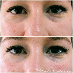 A Perfect You - Tear trough filler before and after