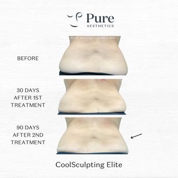 Pure Aesthetics - CoolSculpting at Pure Aesthetics - Medical Spas Near Me - Gainesville, Florida