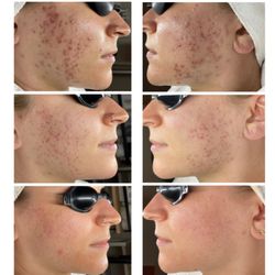 Acne Specialists of Long Beach - Progress pics!