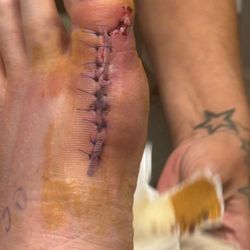 McVay Foot & Ankle - Post suregery from 1st visit to after sutures removed.