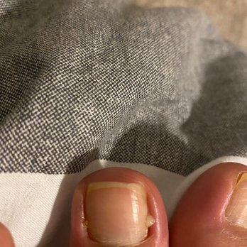 Sparkle Nails - Infected toe - Nail Salons Near Me - Lake Mary, Florida