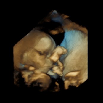 Ikehara Richard T MD - 3D pic of baby at +19 weeks - Obstetricians & Gynecologists Near Me - Honolulu, Hawaii Ikehara Richard T MD - 3D pic of baby at +19 weeks - Obstetricians & Gynecologists Near Me - Honolulu, Hawaii