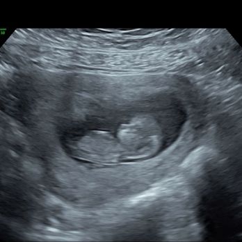 Peek A View Baby - 11w1d 2D - Ultrasound Imaging Centers Near Me - Chesapeake, Virginia Peek A View Baby - 11w1d 2D - Ultrasound Imaging Centers Near Me - Chesapeake, Virginia