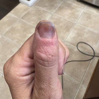 True Touch Nails Spa - Allergic reaction to cheap acrylic - Nail Salons Near Me - Corona, California