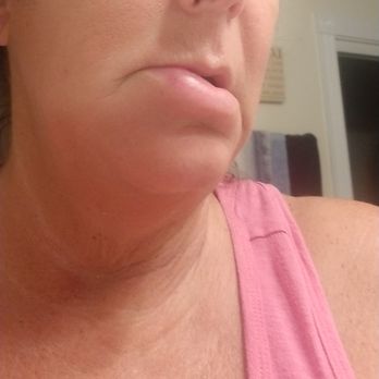 Naples Bay Dental Group - Swollen face and lips from ear to throat - Dental Hygienists Near Me - Naples, Florida