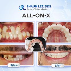 Shaun Lee DDS: Dental Implant and General Dentistry of Auburn - Case Study: All-on-X