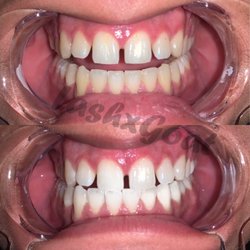 Lashx Goat By Mariah - Tooth whitening before/after