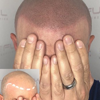 Full Micropigmentation - Hair Loss Centers Near Me - Las Vegas, Nevada Full Micropigmentation - Hair Loss Centers Near Me - Las Vegas, Nevada