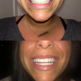 Teeth whitening!! Didn't finish the last session- it hurt a lot but I love my teeth Teeth whitening!! Didn't finish the last session- it hurt a lot but I love my teeth