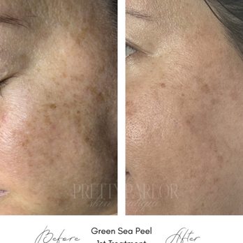The Pretty Parlor Skin Boutique - Green Sea Peel - Waxing Near Me - Humble, Texas The Pretty Parlor Skin Boutique - Green Sea Peel - Waxing Near Me - Humble, Texas