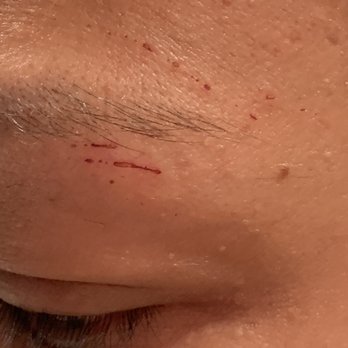 Eyebrown Designer 21 - My left eye where skin was removed by the threading. - Eyebrow Services Near Me - Albuquerque, New Mexico