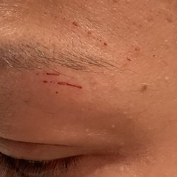 Eyebrown Designer 21 - My left eye where skin was removed by the threading.