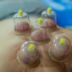 Misty Ann Massage & Herbal Health - Cupping to bring bloody flow and decrease tension in the upper back before proceeding with deep tissue techniques