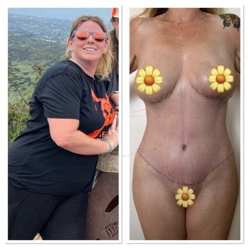 Ron Soltero, Plastic Surgeon - Me from one year ago and me 4wpo - Cosmetic Surgeons Near Me - San Diego, California Ron Soltero, Plastic Surgeon - Me from one year ago and me 4wpo - Cosmetic Surgeons Near Me - San Diego, California