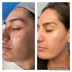 Classy Waxing Salon - Chemical Peel! Helping my client to reduce her hyper pigmentation, or dark spot, sun damage! she loved her results! come get yours done!!