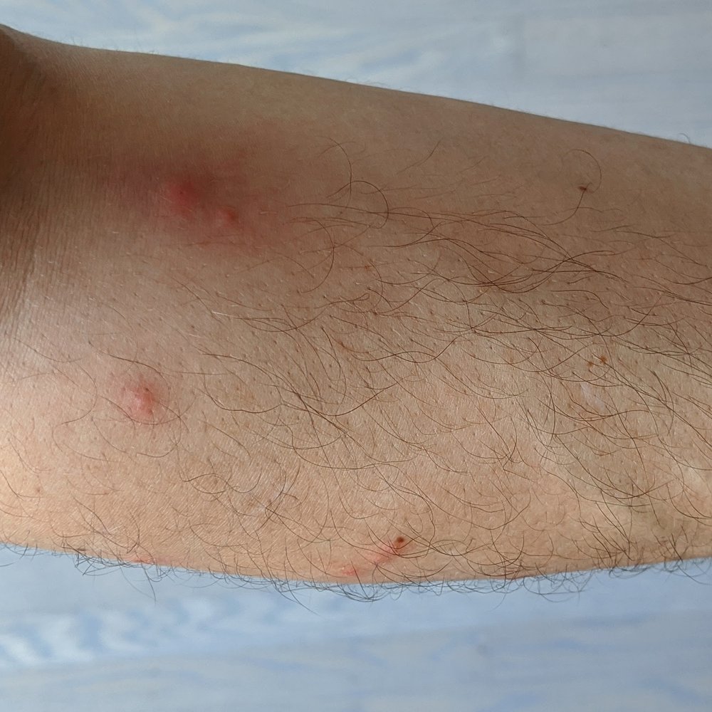 Baymont by Wyndham Willows - Flea bites from Room 129 - Hotels Near Me - Willows, California