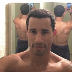 Bosley Hair Restoration & Transplant - 7 months post FUE