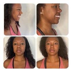 Body By Lonnie Med Spa - Under Eye & Cheek Filler make a huge difference in facial sculpting. Ask our injector specialist for suggestions on facial sculpting.