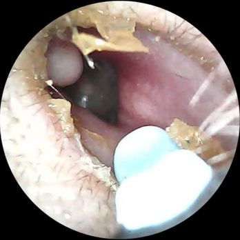 Calabasas Concierge MD - Ear infection that Dr Hakman treated ASAP - Concierge Medicine Near Me - Calabasas, California