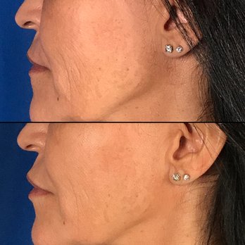 Timothy M Jochen, MD - Actual Timothy Jochen, MD patient. Restylane Defyne in Cheeks and Lips. - Dermatologists Near Me - Rancho Mirage, California