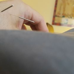 Orem Community Acupuncture - Treatment points on dorsal aspect of hand