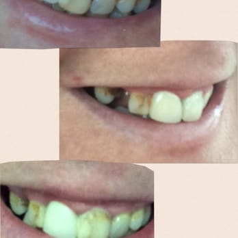 We Care Dental - This is the half way stage of getting my smile back. Normally I would hide this pic but want to share so others can - General Dentistry Near Me - Rancho Mirage, California We Care Dental - This is the half way stage of getting my smile back. Normally I would hide this pic but want to share so others can - General Dentistry Near Me - Rancho Mirage, California