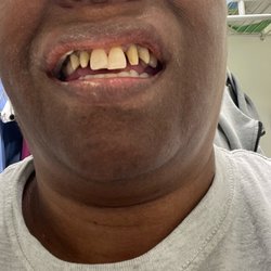 Family Dental Care Center - Before front teeth extraction and replacement