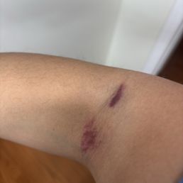 Bruising and under skin bleeding from improperly drawing blood. Bruising and under skin bleeding from improperly drawing blood.