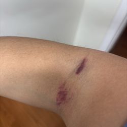 Quest Diagnostics - Bruising and under skin bleeding from improperly drawing blood.
