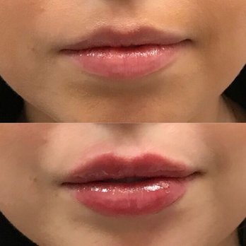Embrace Vanity - Before / immediately after 1 syringe Restalyne Refyne - Medical Spas Near Me - Pasadena, California Embrace Vanity - Before / immediately after 1 syringe Restalyne Refyne - Medical Spas Near Me - Pasadena, California