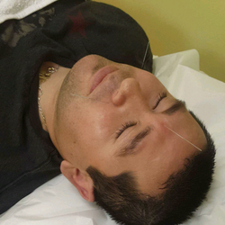 Advanced Acupuncture - Acupuncture