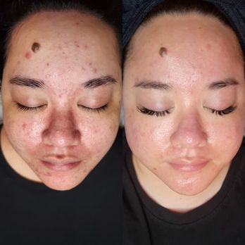 Wonderland Spa - Before & after acne and brightening treatments. - Skin Care Near Me - Phoenix, Arizona Wonderland Spa - Before & after acne and brightening treatments. - Skin Care Near Me - Phoenix, Arizona