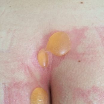 120 Acupuncture Clinic - 2 hours after Dr Ko 'treated' him. Second degree burns. The blisters were the size of a quarter and half inch high. - Acupuncture Near Me - Studio City, California