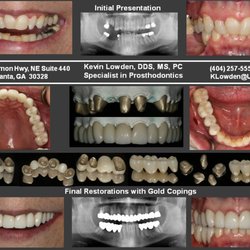 Atlanta Dental Restorative Specialist - Full Mouth Rehabilitation with Gold Copings