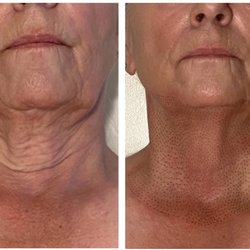 Neck lift