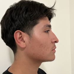 Acne Specialist Marlene Wolfberg