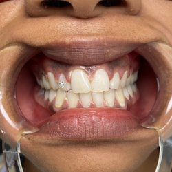 Gem and whitening session
