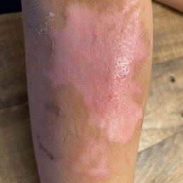 Two weeks after seeing Dr. Bang.  What a difference.