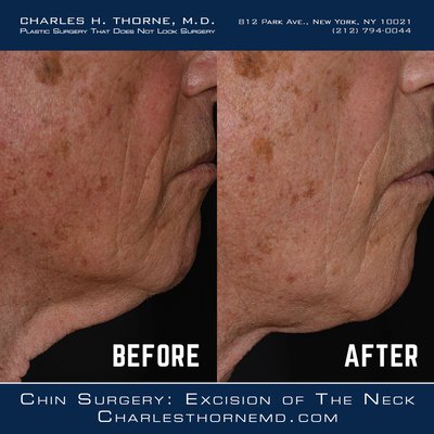 Chin Surgery Before & After Plastic Surgery - Most patients can be helped with a chin implant. This is a simple, dependable procedure that can be performed in the office under local anesthesia. Implants are made from various artificial materials but I prefer to use silastic implants in most cases. The implant can be inserted either through an incision in the mouth or an incision under the chin. While it might seem logical to use the incision in the mouth to hide the scar, the risk of infection is higher when this is done and therefore I usually recommend an external incision. The scar is almost invisible in the long run.