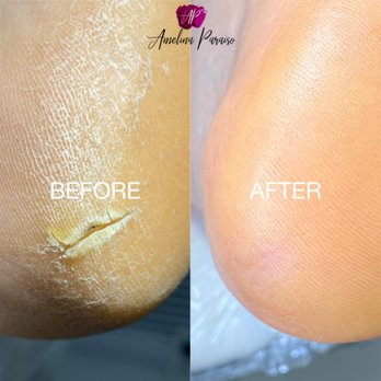 Amelina Paraiso - Before and After E-file Pedicure + Deep Fissure Reduction - Nail Salons Near Me - Des Plaines, Illinois Amelina Paraiso - Before and After E-file Pedicure + Deep Fissure Reduction - Nail Salons Near Me - Des Plaines, Illinois