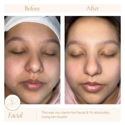 Top Tier Aesthetics - Beautiful client glowing after her facial