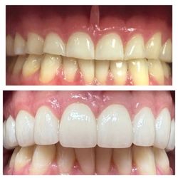Dedicated Dental Group - Before and After top teeth Smile Makeover