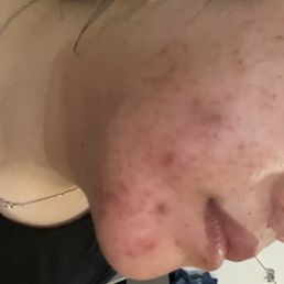 My skin in the beginning (December 2022) My skin in the beginning (December 2022)