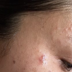 Vera Nail Spa - Wax burn