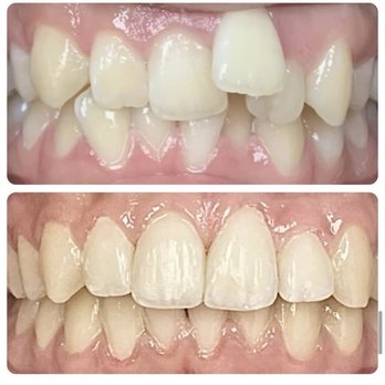 Vancouver Dental Care - Braces transformation - General Dentistry Near Me - Vancouver, Washington Vancouver Dental Care - Braces transformation - General Dentistry Near Me - Vancouver, Washington