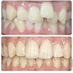 Vancouver Dental Care - Braces transformation