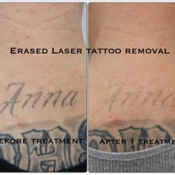 Erased Laser Tattoo Removal